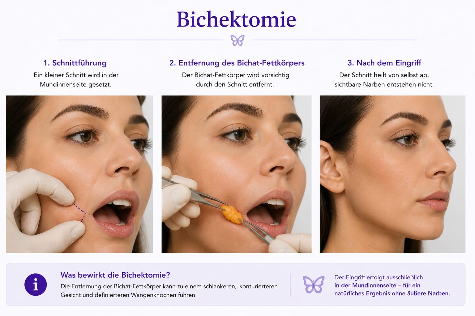 Bichektomie – Wangenfettentfernung
