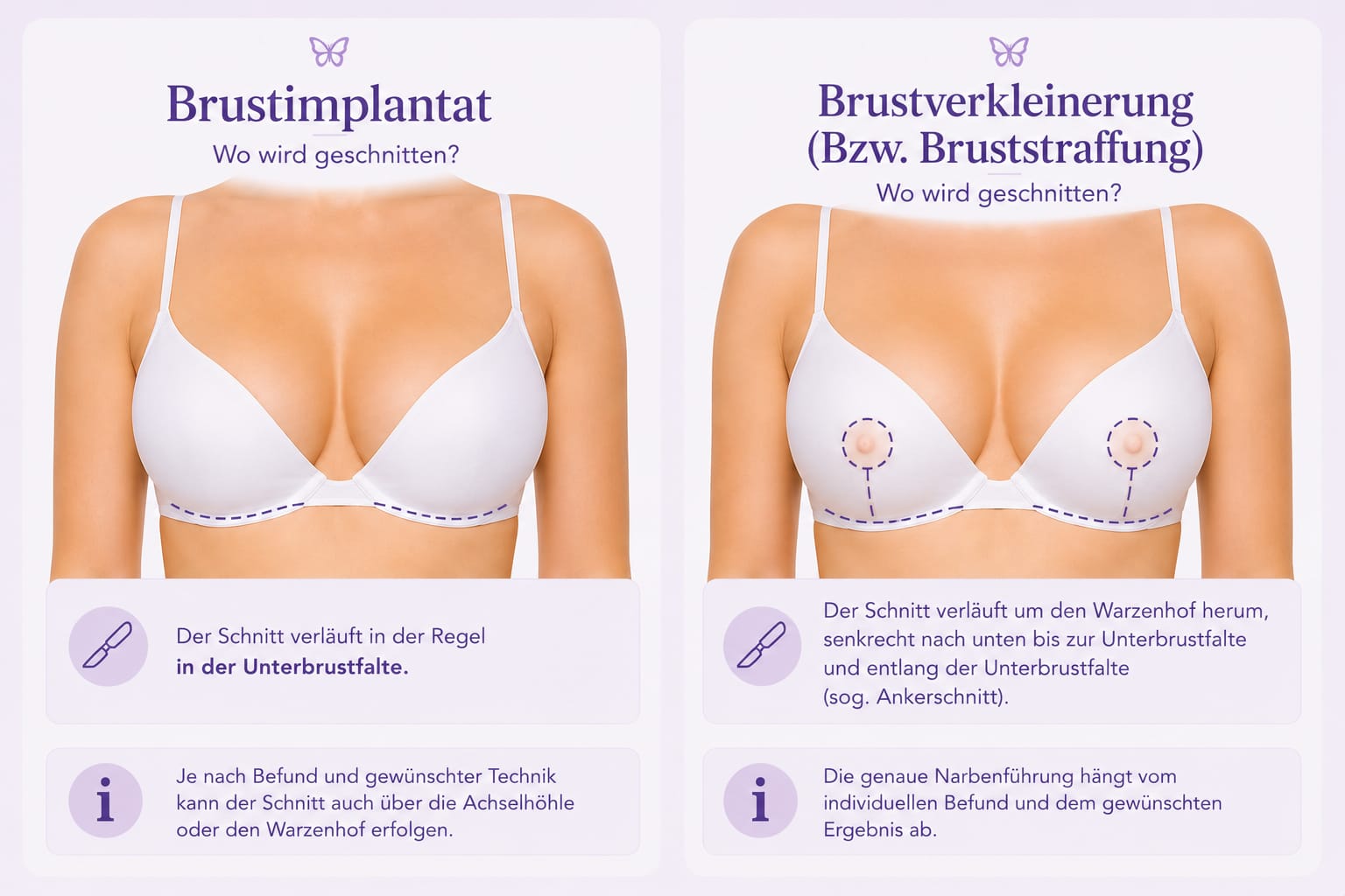 Bruststraffung – Schnittführung
