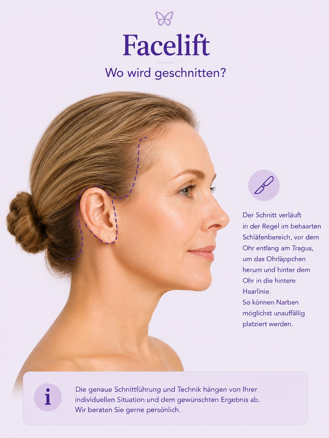 Facelifting – Methoden im Überblick