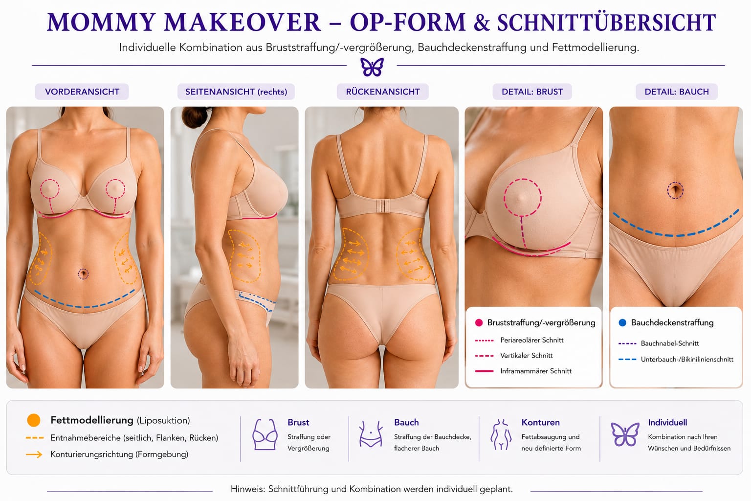 Mommy Makeover – OP-Übersicht