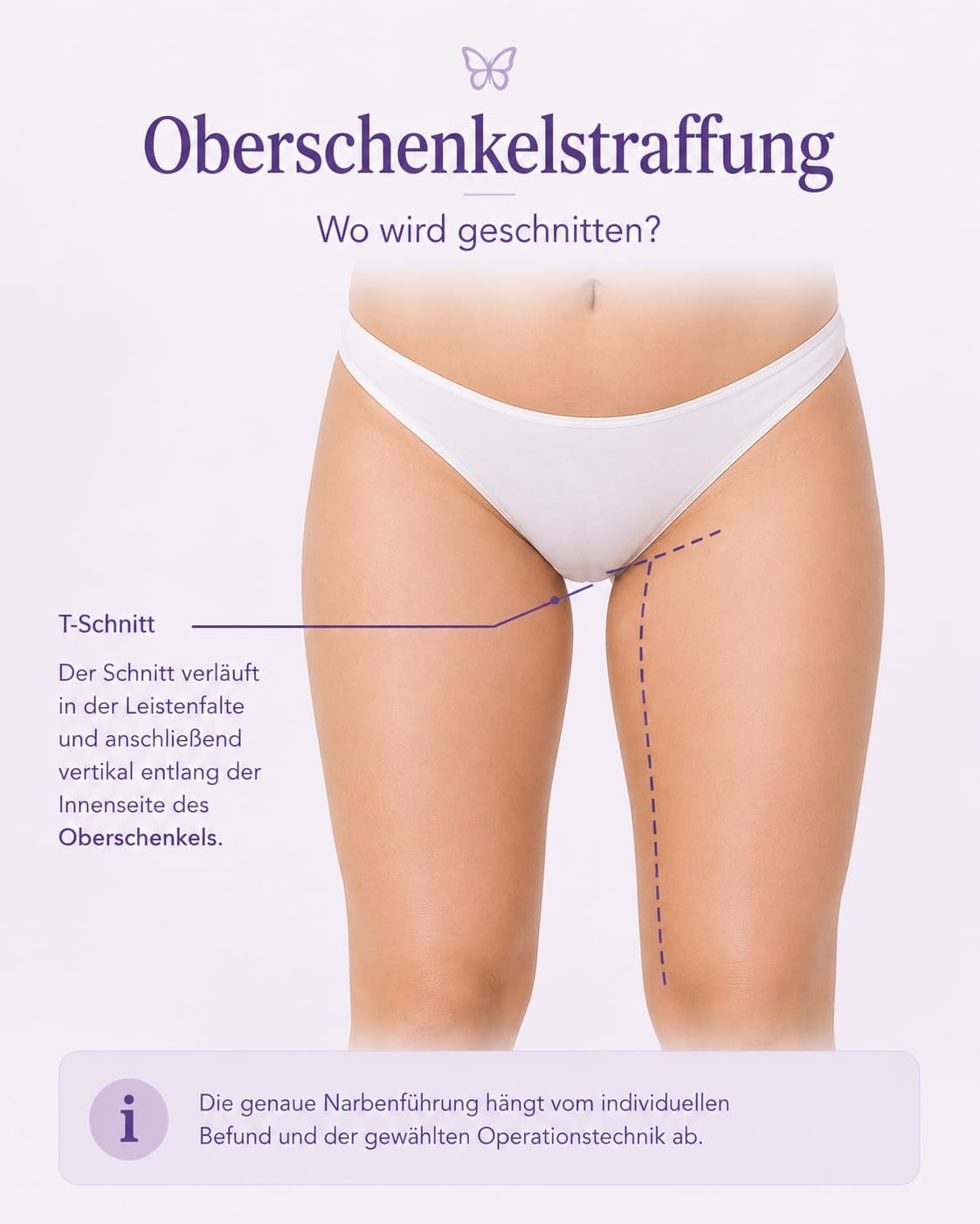 Oberschenkelstraffung