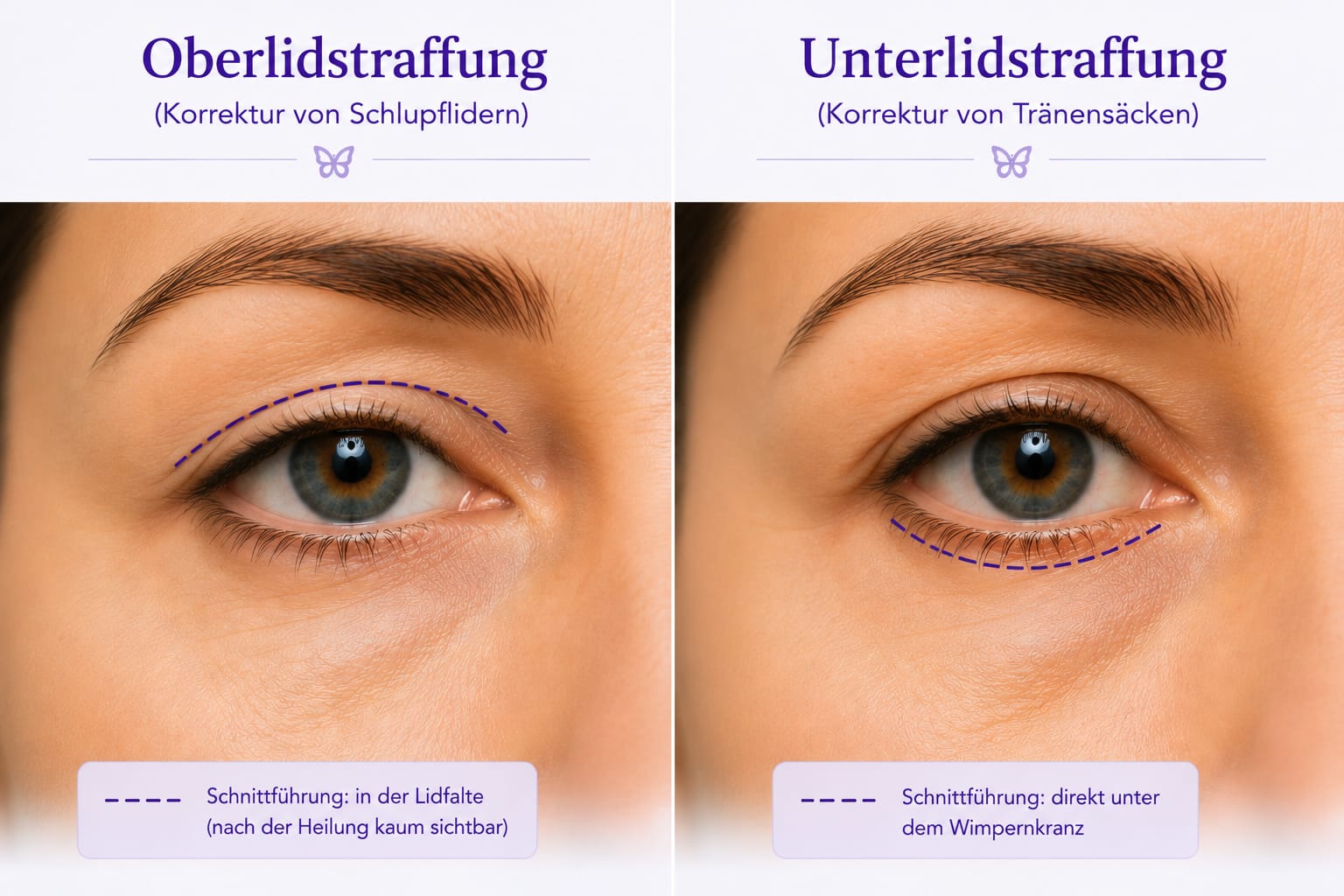 Okuloplastik – Ober- & Unterlidstraffung