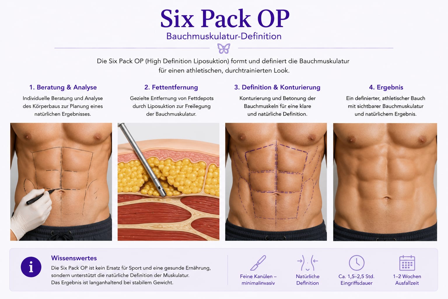 Six-Pack-OP / Bauchmuskel-Definition