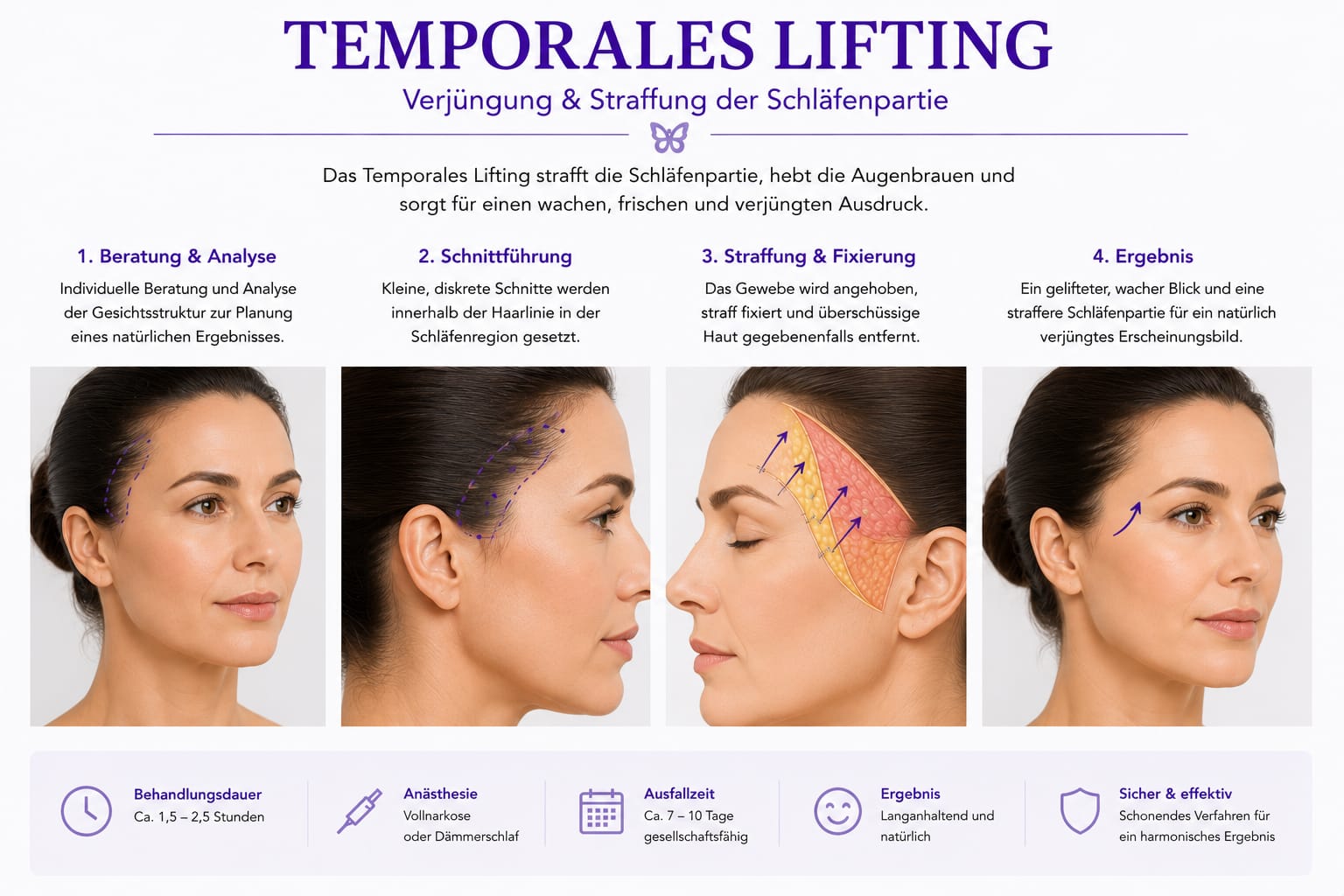Temporales Lifting
