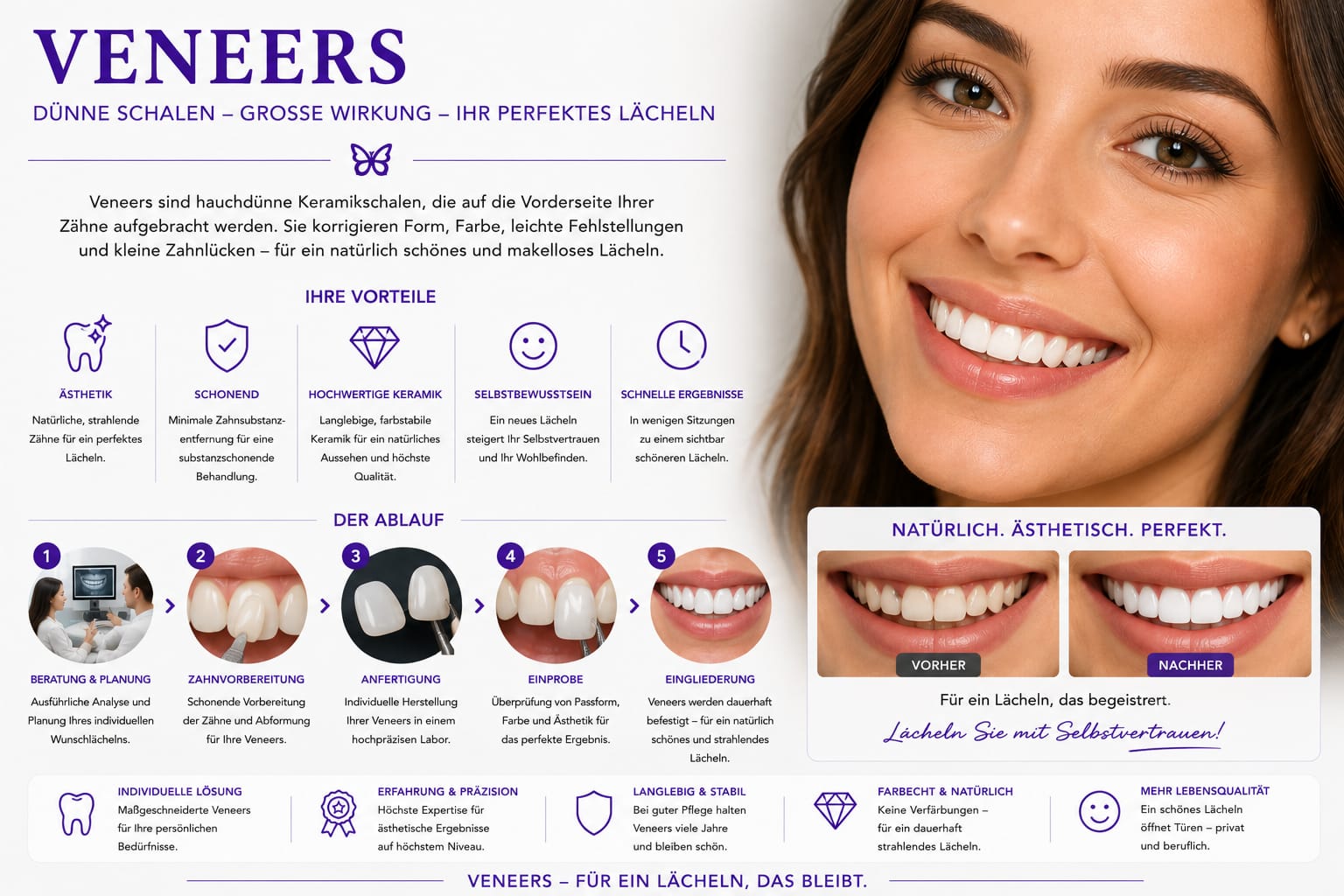 Veneers